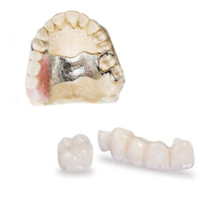 The Essential Types Of Dental Prosthesis Teeth Options Dental Lab Shop