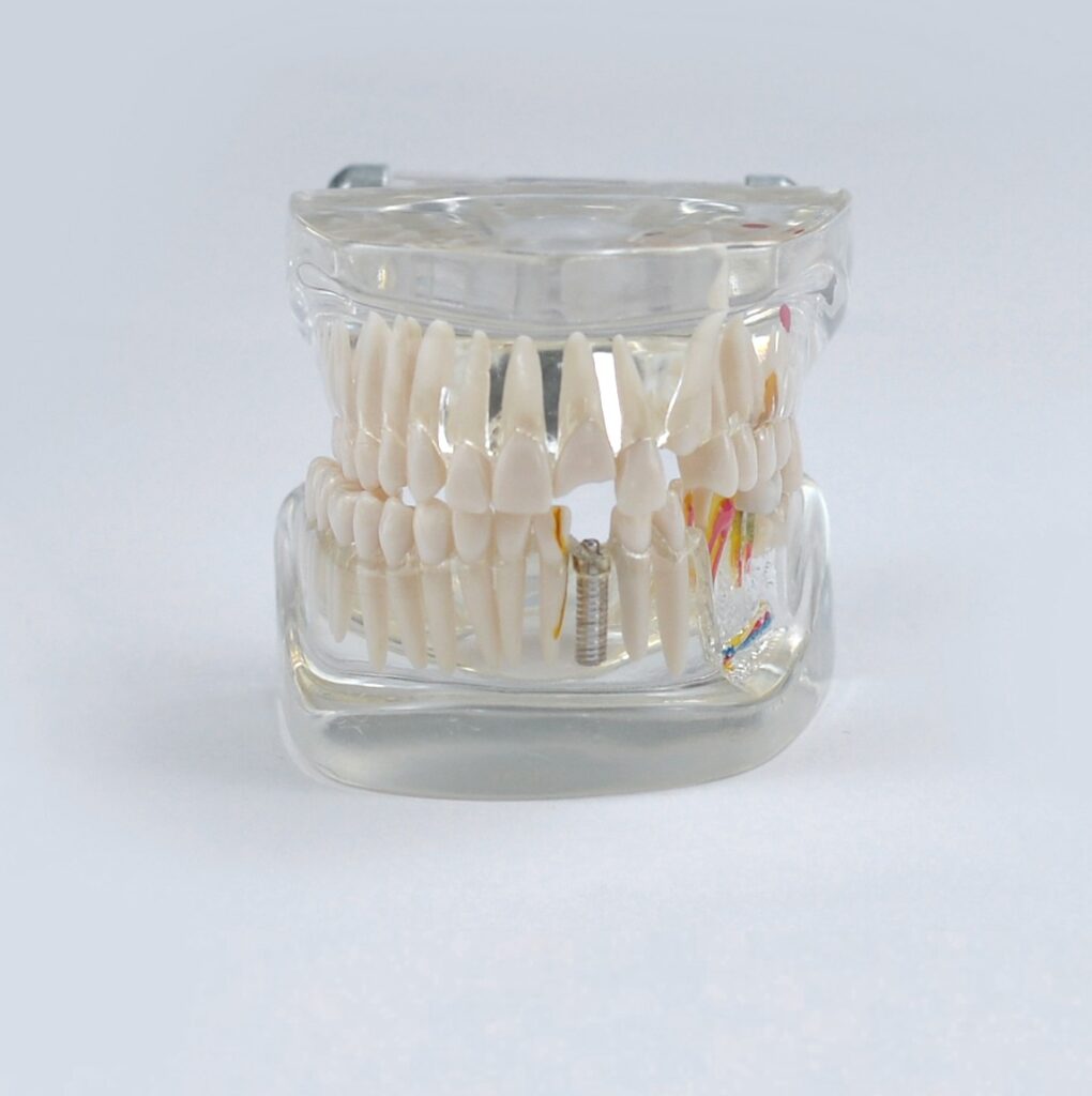 Translucent Pathological Implant Model, $45.99, November 2024 - Dental ...