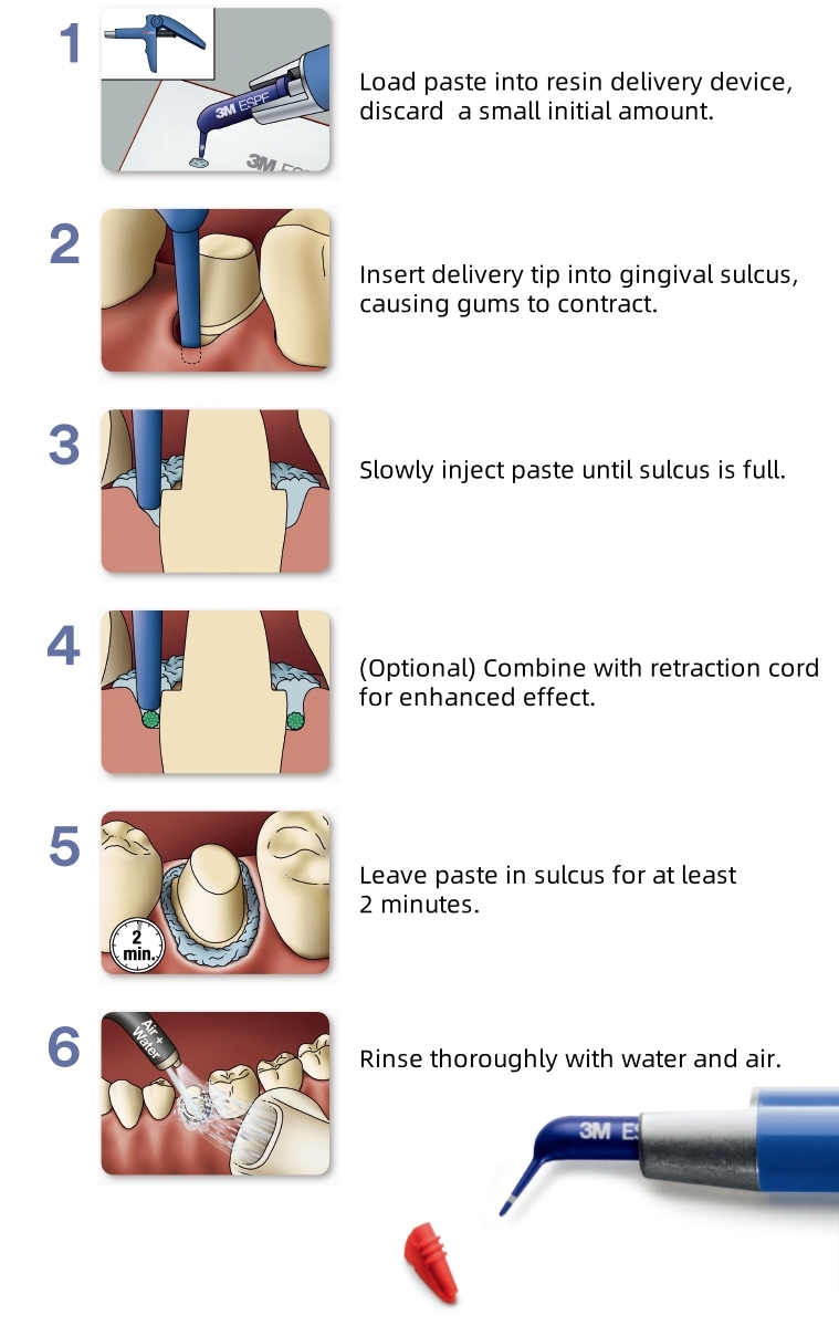 Astringent Retraction Paste Operation Sequence